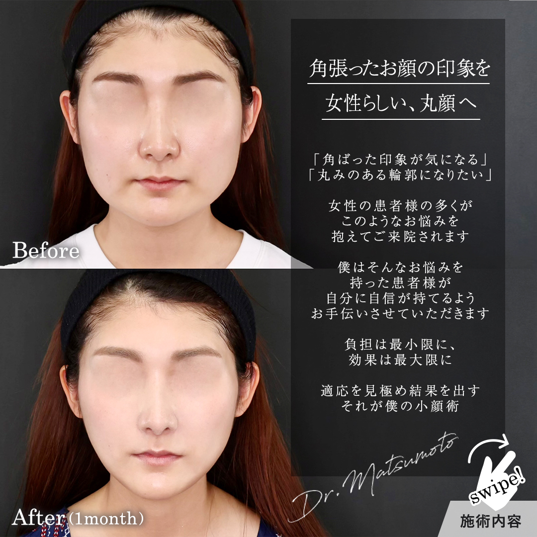 TAC式 ツヤ肌コラーゲンリフト®/Lラインファット除去(エラ下脂肪除去)/エラボトックス注射の症例写真 施術前後