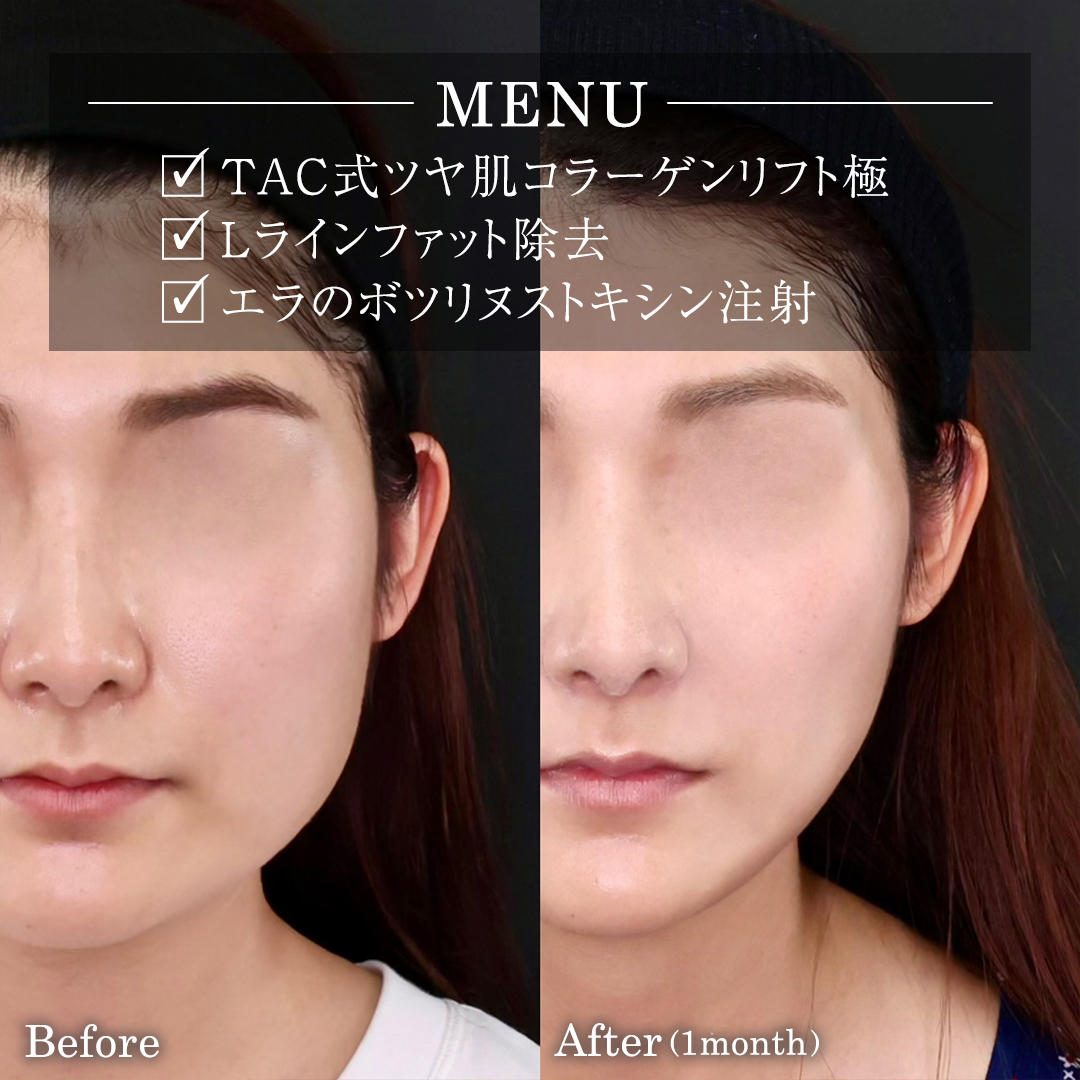 TAC式 ツヤ肌コラーゲンリフト®/Lラインファット除去(エラ下脂肪除去)/エラボトックス注射の症例写真 施術前後