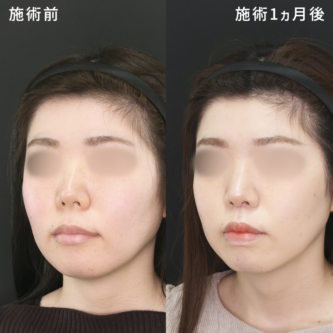 【人中短縮術】気になる鼻の下を短くし幼顔印象に