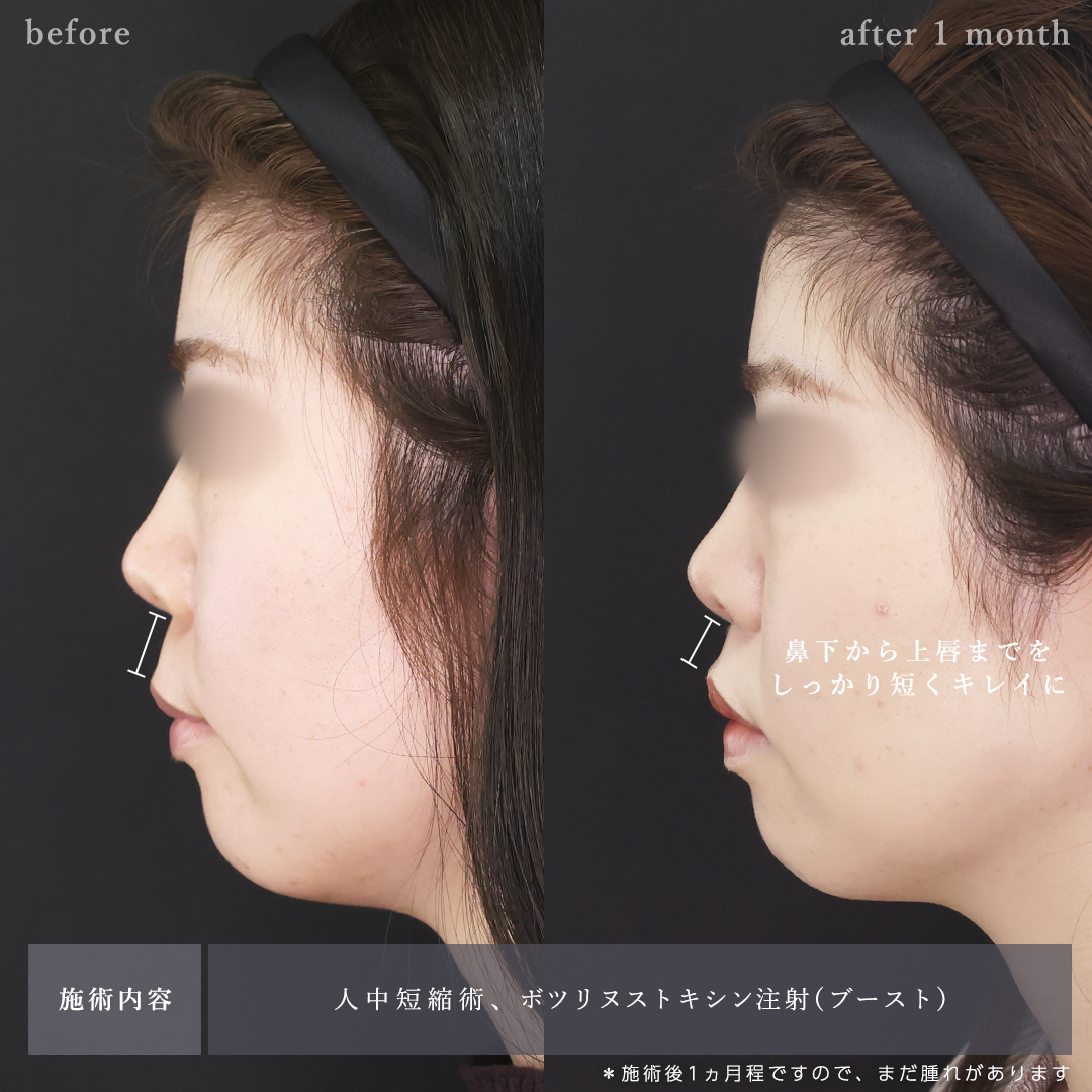 人中短縮術(リップリフト)・外側人中短縮術/ボトックス注射：その他の症例写真 施術前後 