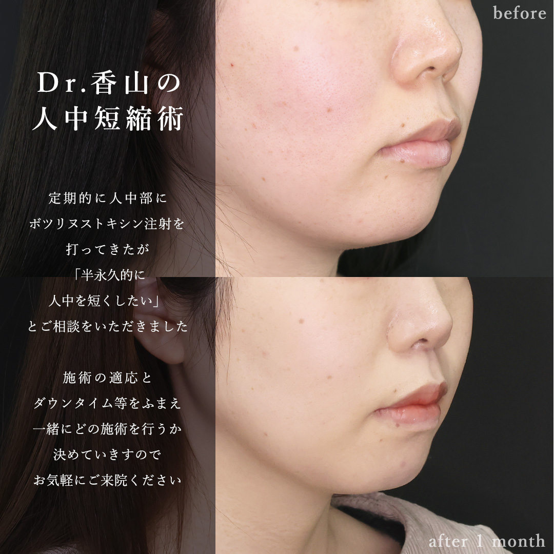 人中短縮術(リップリフト)・外側人中短縮術/ボトックス注射：その他の症例写真 施術前後 