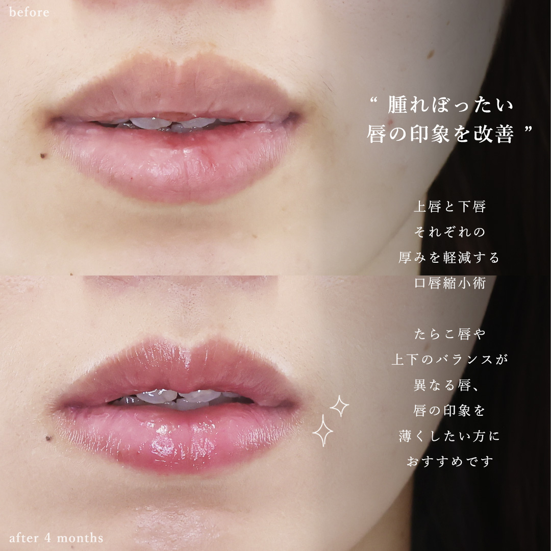 口唇縮小術/顔の脂肪注入(コンデンスリッチフェイス)/おでこの脂肪注入（オルチャンデコ形成）の症例写真 施術前後 