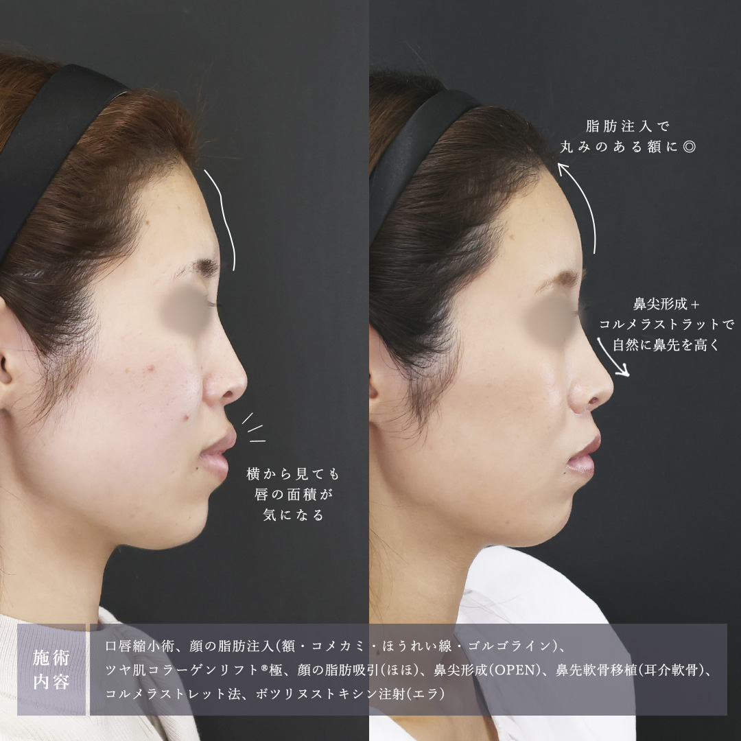 口唇縮小術/顔の脂肪注入(コンデンスリッチフェイス)/おでこの脂肪注入（オルチャンデコ形成）の症例写真 施術前後 