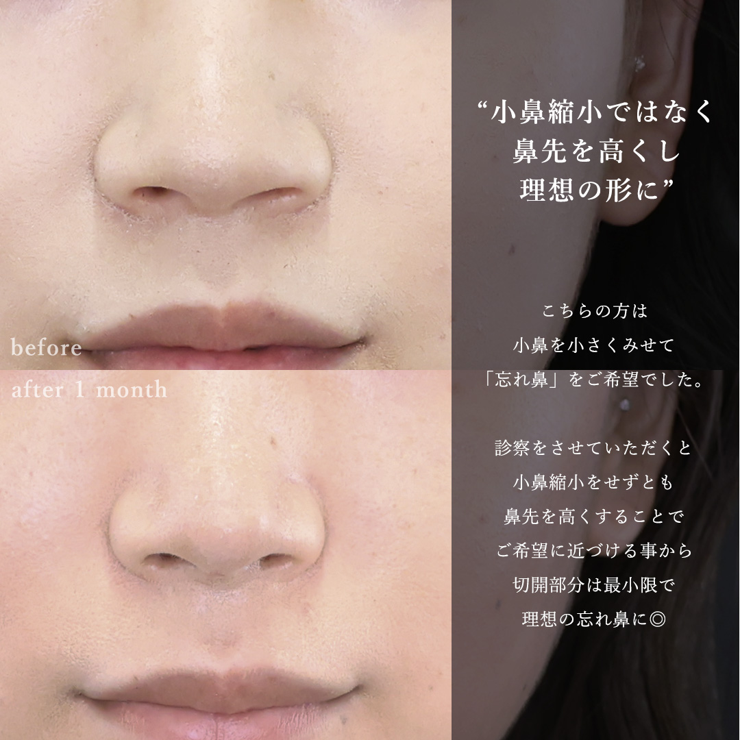 鼻尖形成・鼻尖縮小/鼻先軟骨移植の症例写真 施術前後