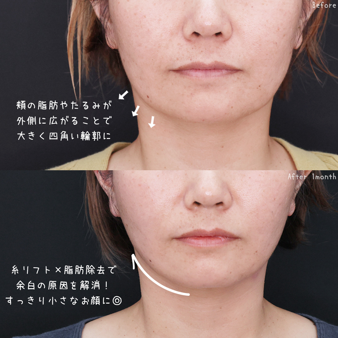 TAC式 ツヤ肌コラーゲンリフト®/顎下の脂肪吸引の症例写真 施術前後 