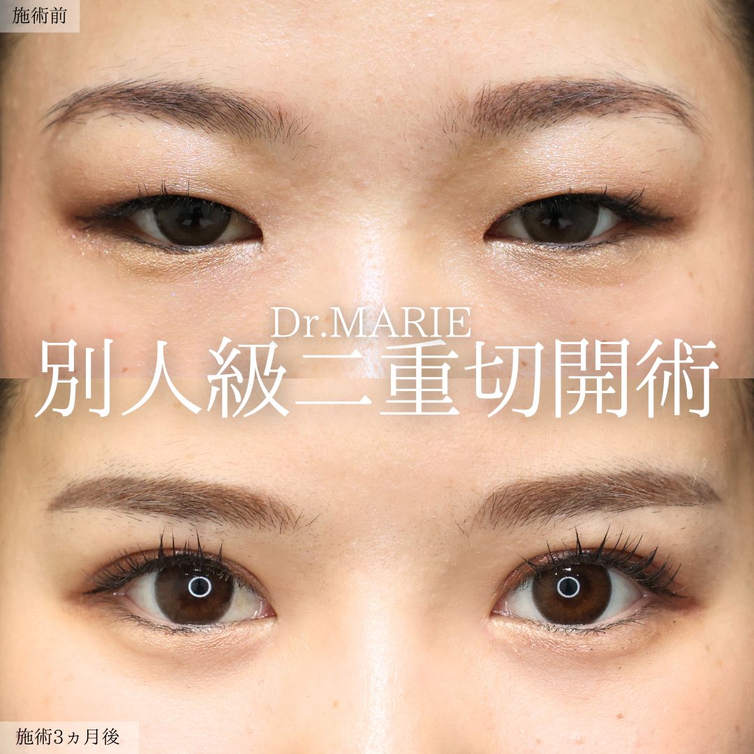 バッカルファット除去/ジョールファット除去/小顔整形｜パーフェクトフェイスラインの症例写真 施術前後 