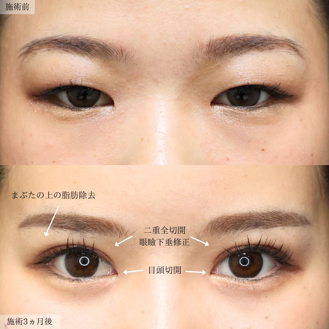 バッカルファット除去/ジョールファット除去/小顔整形｜パーフェクトフェイスラインの症例写真 施術前後 