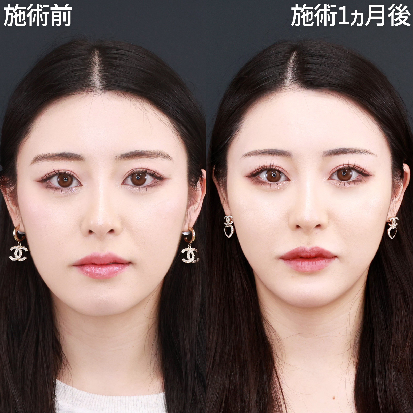 【糸リフト＆ヒアルロン酸】短いダウンタイムで、自然に垢抜ける！