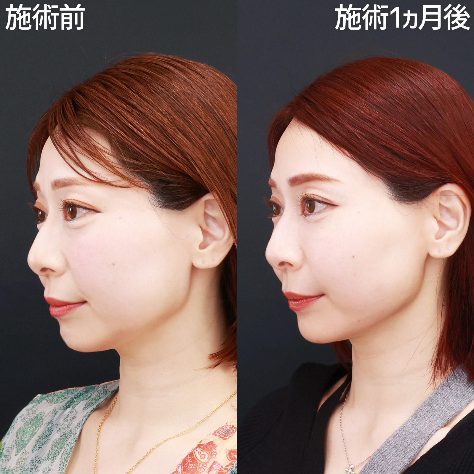 TAC式 ツヤ肌コラーゲンリフト®/ほうれい線のヒアルロン酸注射/ボトックス注射：その他の症例写真 施術前後 