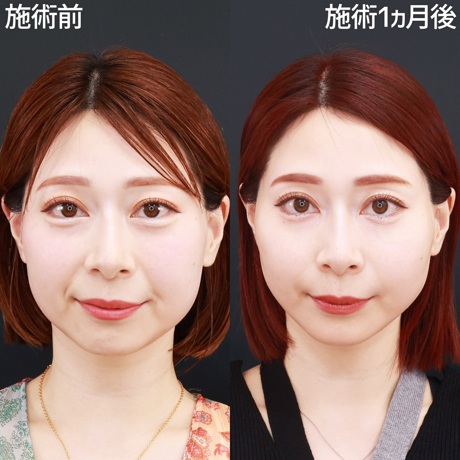 【糸リフト極＆ヒアルロン酸】たるみやシワを改善！より若々しい印象に