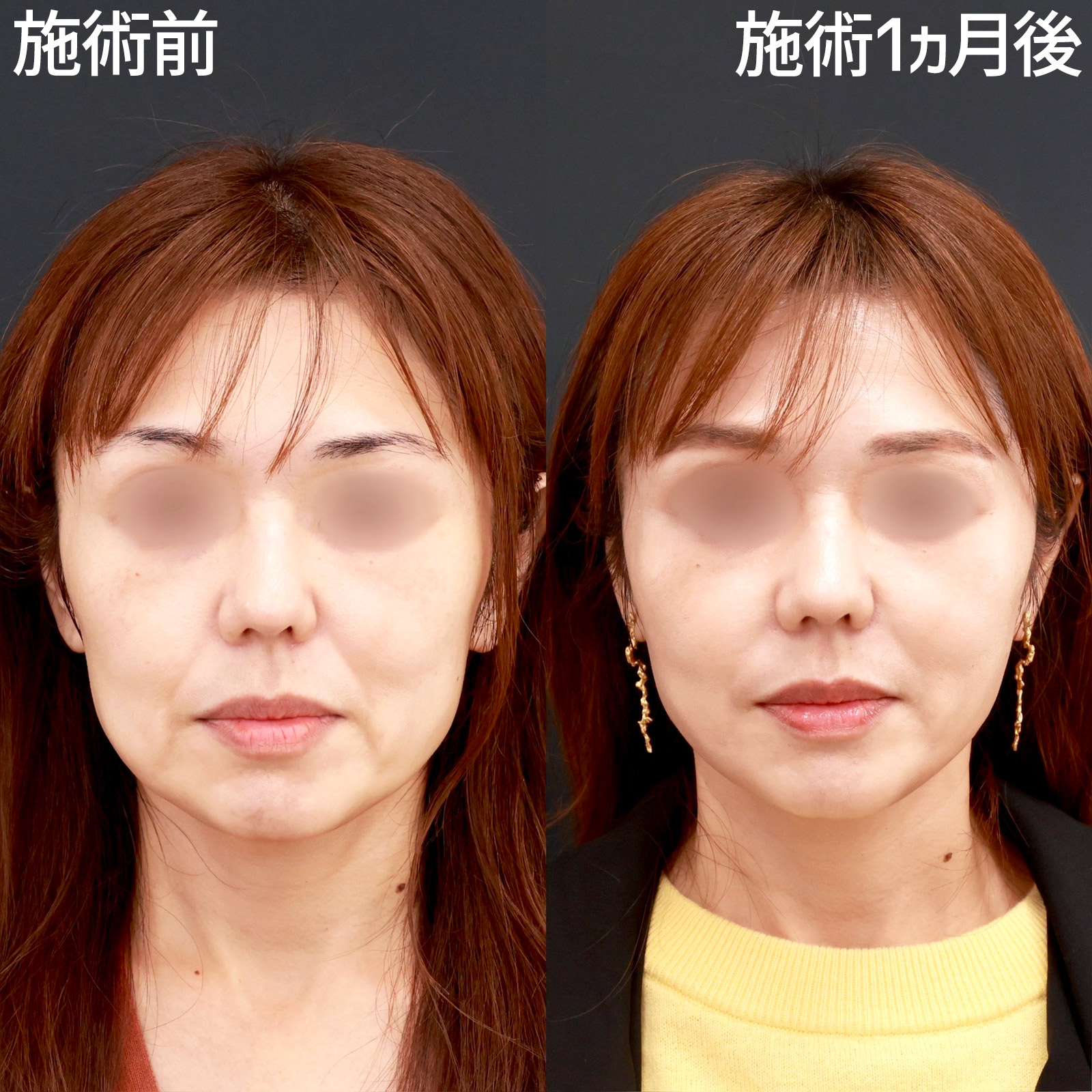 【小顔整形】自然だけど確実に変わる！アンチエイジングなら糸リフトがおすすめ。