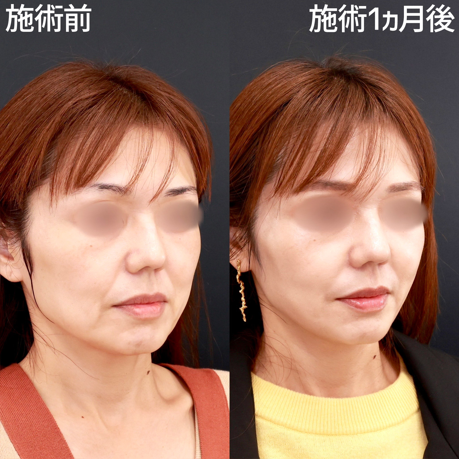 TAC式 ツヤ肌コラーゲンリフト®/ほうれい線のヒアルロン酸注射の症例写真 施術前後 