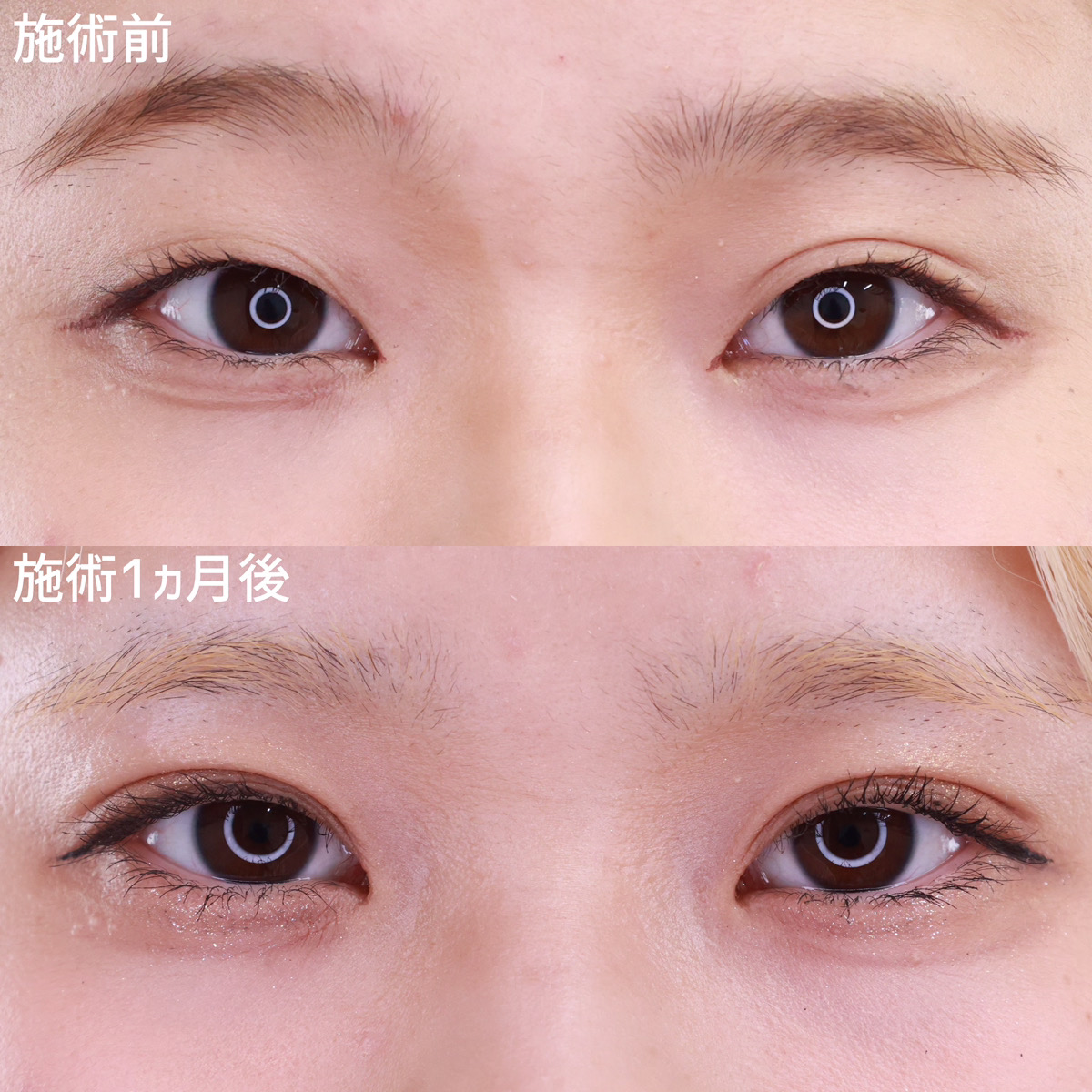 【二重埋没法】左右差を改善！お気に入りの目元に！