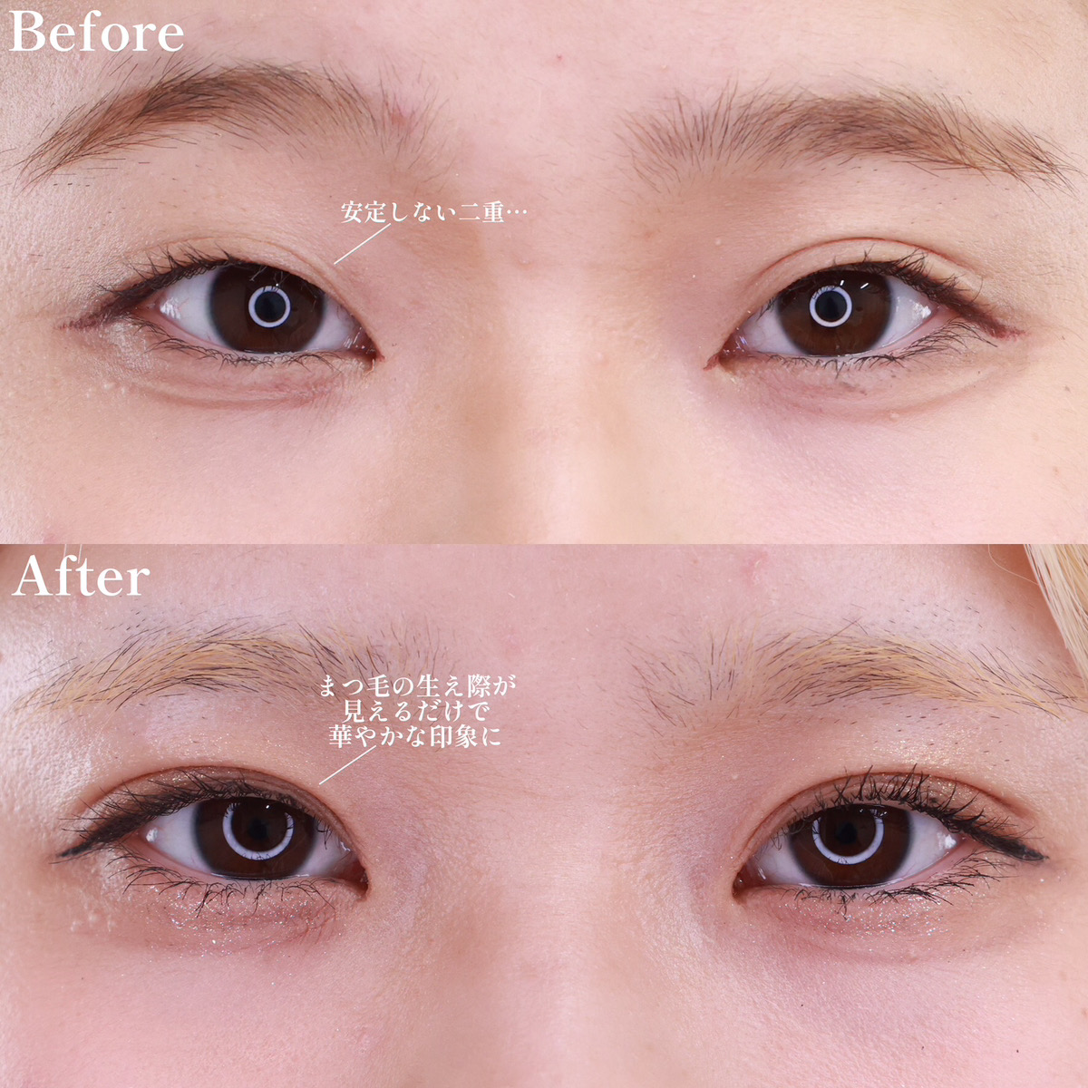 二重埋没法/目元：その他の症例写真 施術前後 