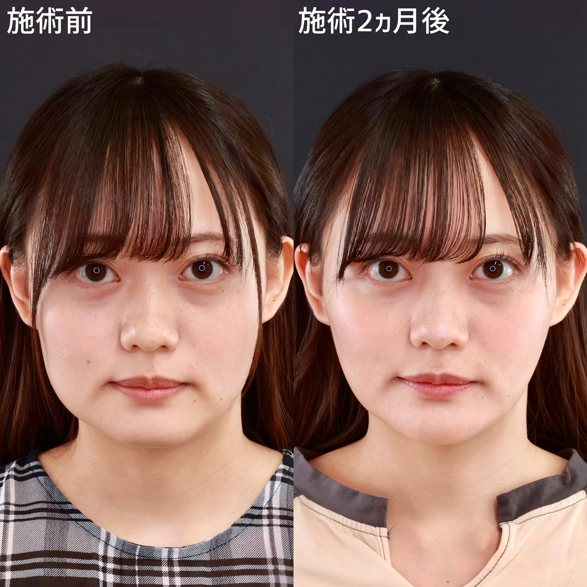 【小顔整形】笑った時にポコッとでるお肉を撃退！垢抜けた印象に！