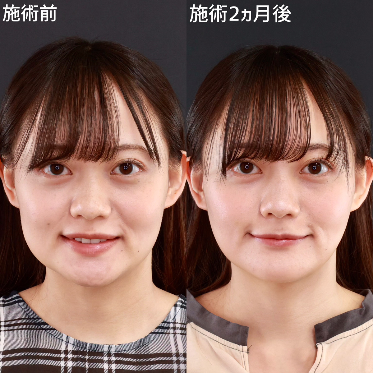 TAC式 ツヤ肌コラーゲンリフト®/バッカルファット除去/顎のヒアルロン酸注射の症例写真 施術前後 