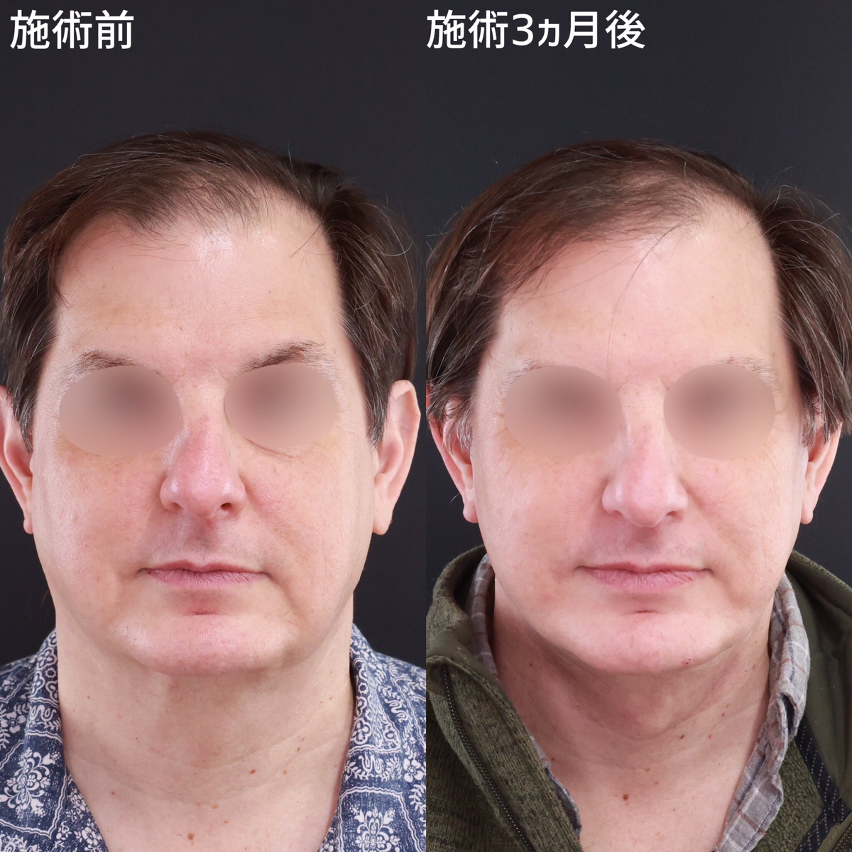 【フルフェイスリフト】切開リフトと脂肪吸引でよりシャープに