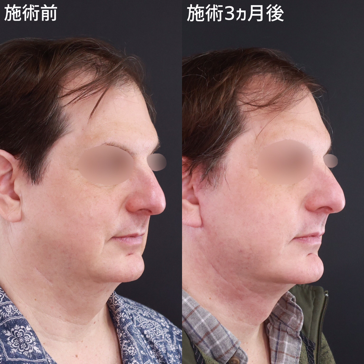 フェイスリフト（切開）/顎下の脂肪吸引/ジョールファット除去の症例写真 施術前後 