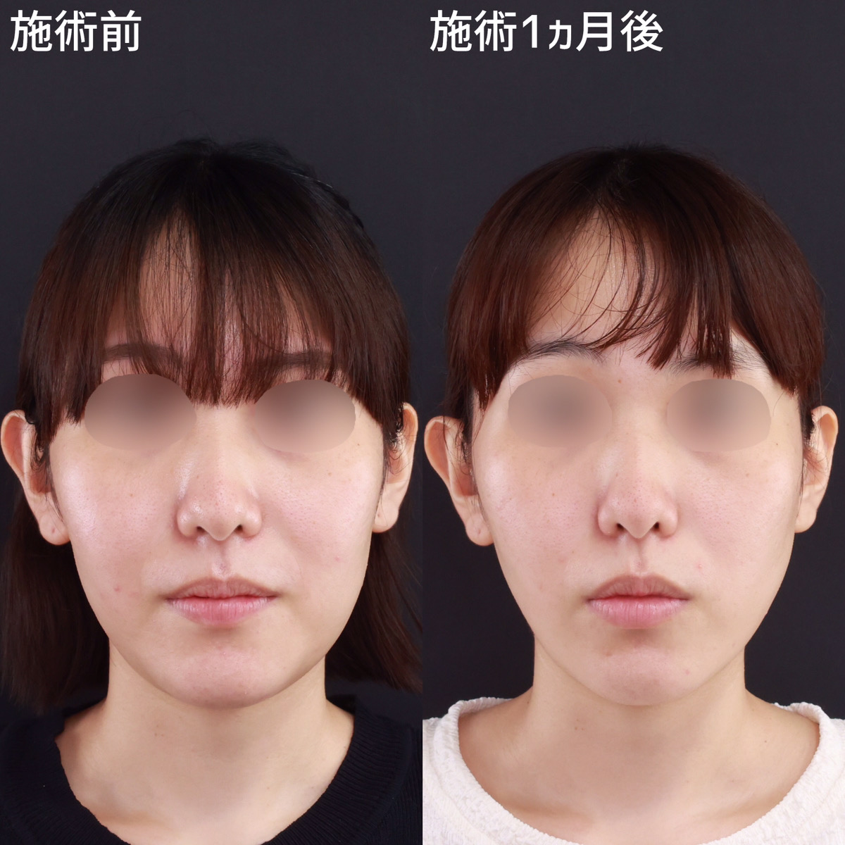 TAC式 ツヤ肌コラーゲンリフト®/エラボトックス注射の症例写真 施術前後 