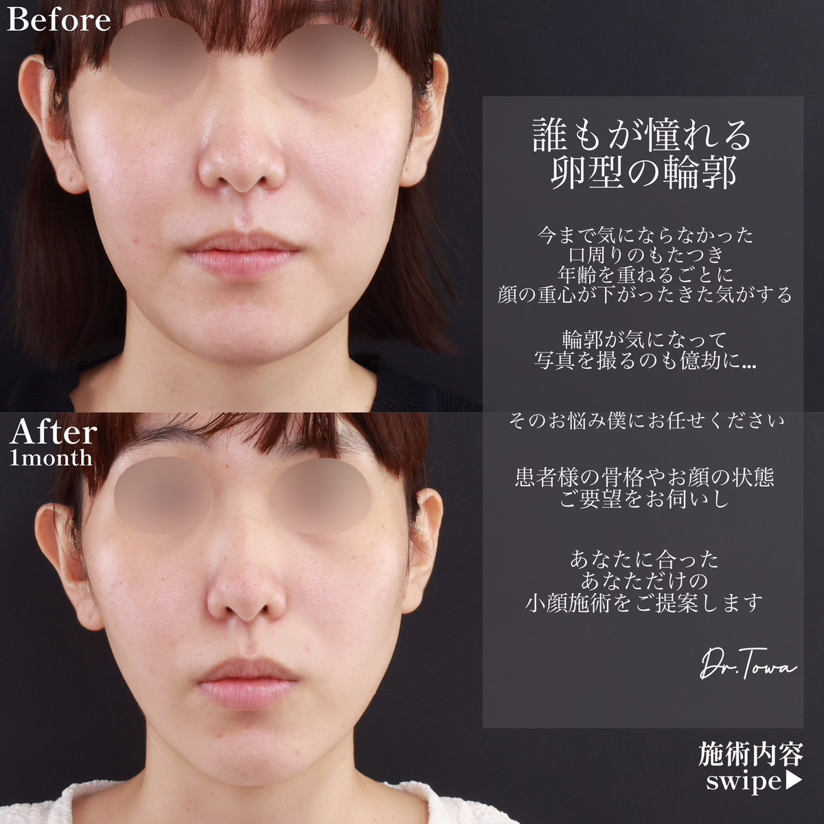 TAC式 ツヤ肌コラーゲンリフト®/エラボトックス注射の症例写真 施術前後 