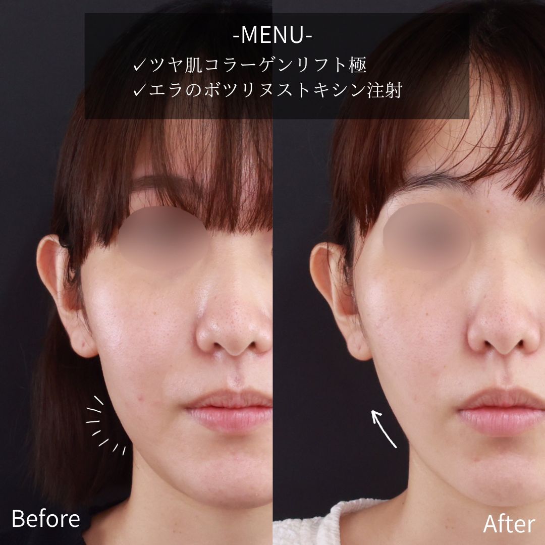 TAC式 ツヤ肌コラーゲンリフト®/エラボトックス注射の症例写真 施術前後 