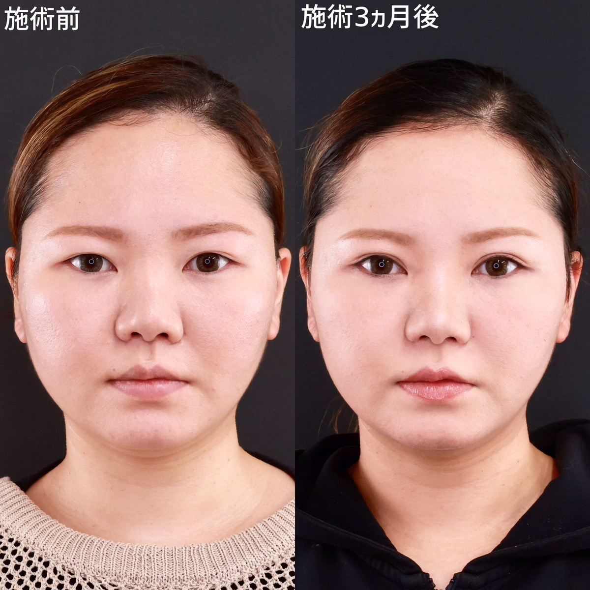 【二重切開＋鼻整形】複合施術で華やかな印象へ