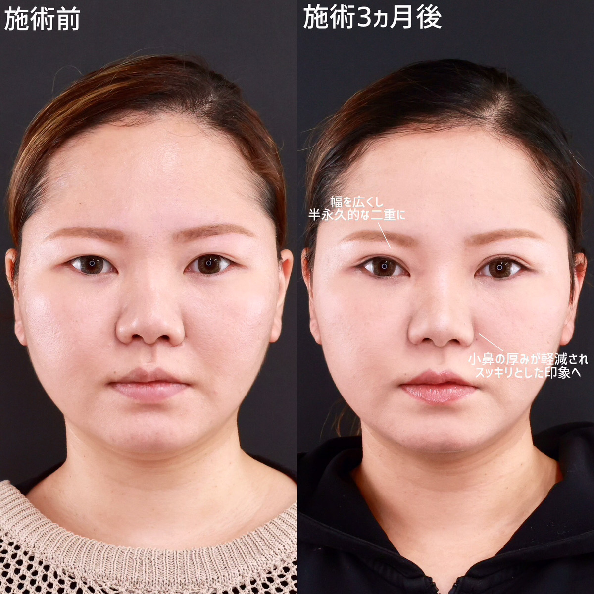 上眼瞼切開術/鼻孔縁挙上術/鼻翼挙上術の症例写真 施術前後 