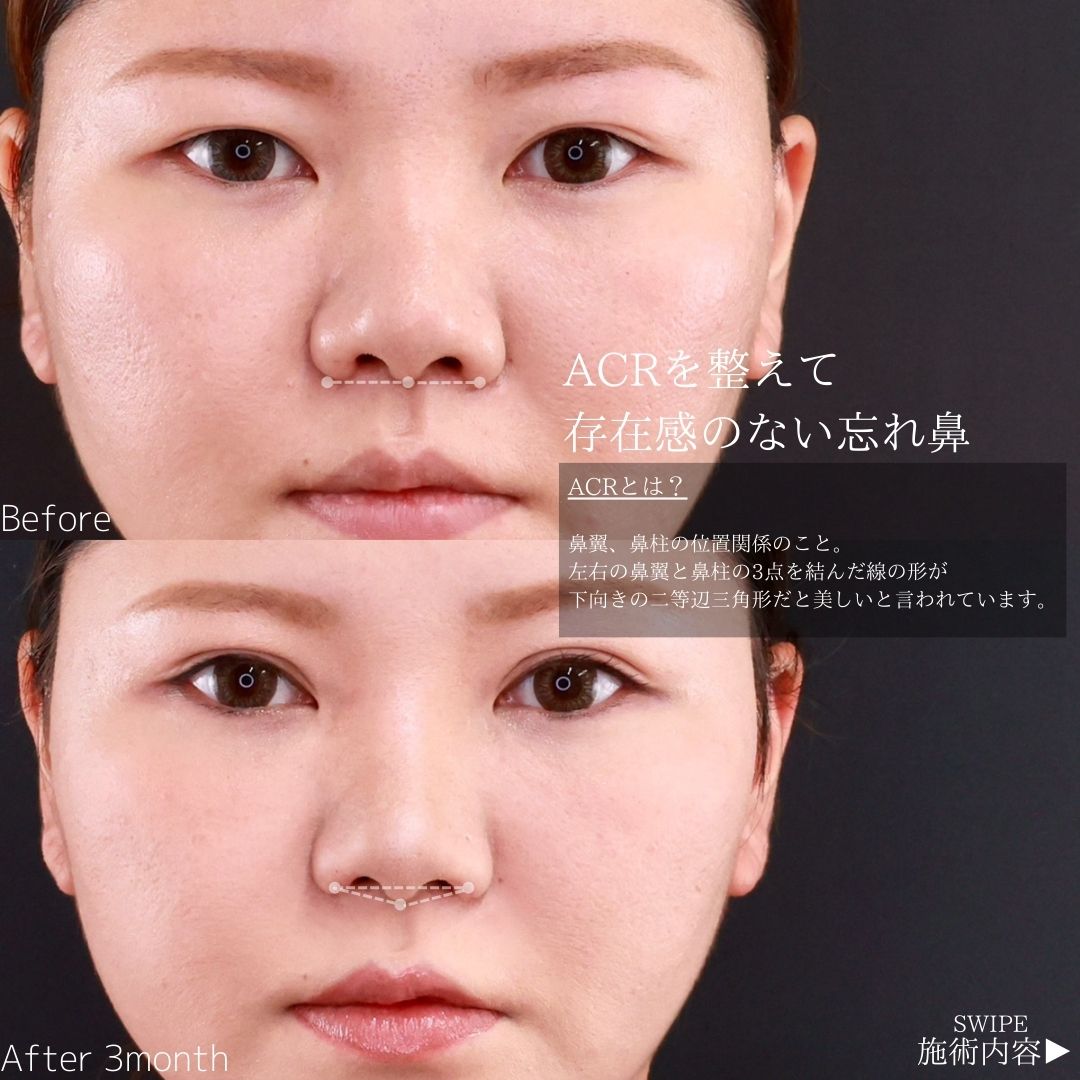 上眼瞼切開術/鼻孔縁挙上術/鼻翼挙上術の症例写真 施術前後 