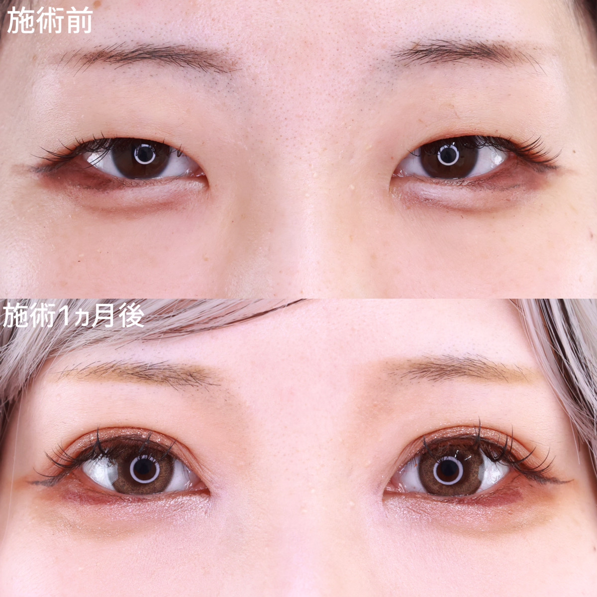 【二重埋没法】憧れの平行型二重で映える目元