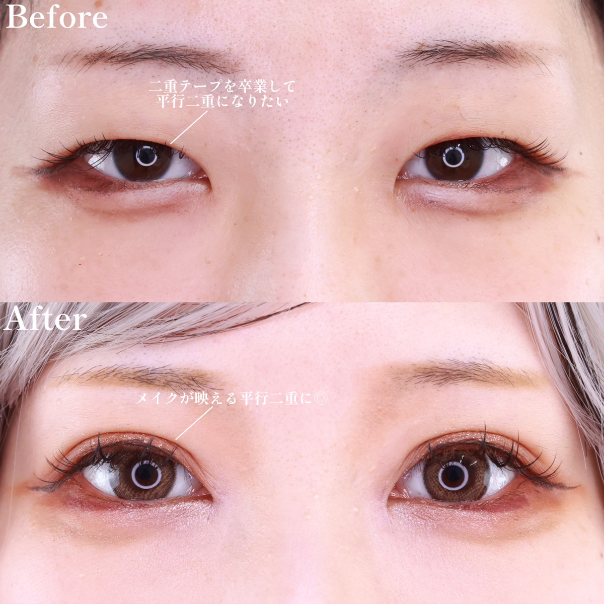 二重埋没法/目頭切開術/目元：その他の症例写真 施術前後 