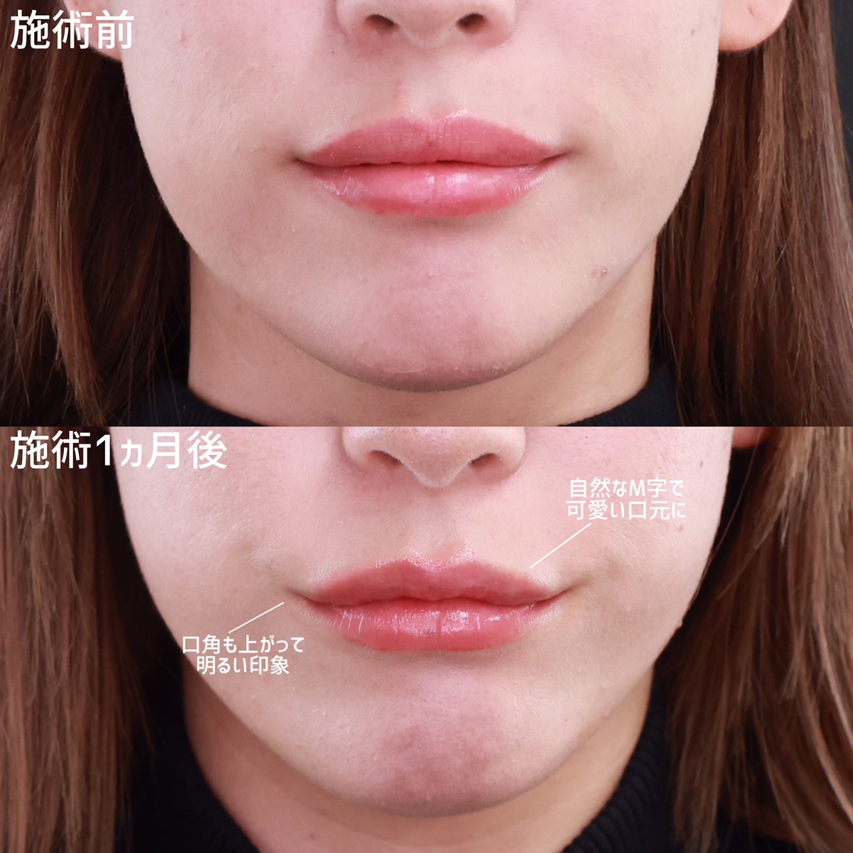 M字リップ形成術の症例写真 施術前後 