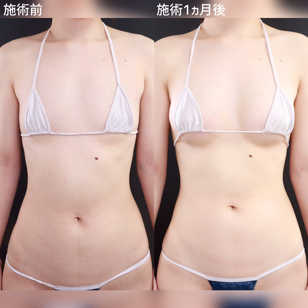 【シリコンバッグ豊胸】どの角度から見ても綺麗なバストへ