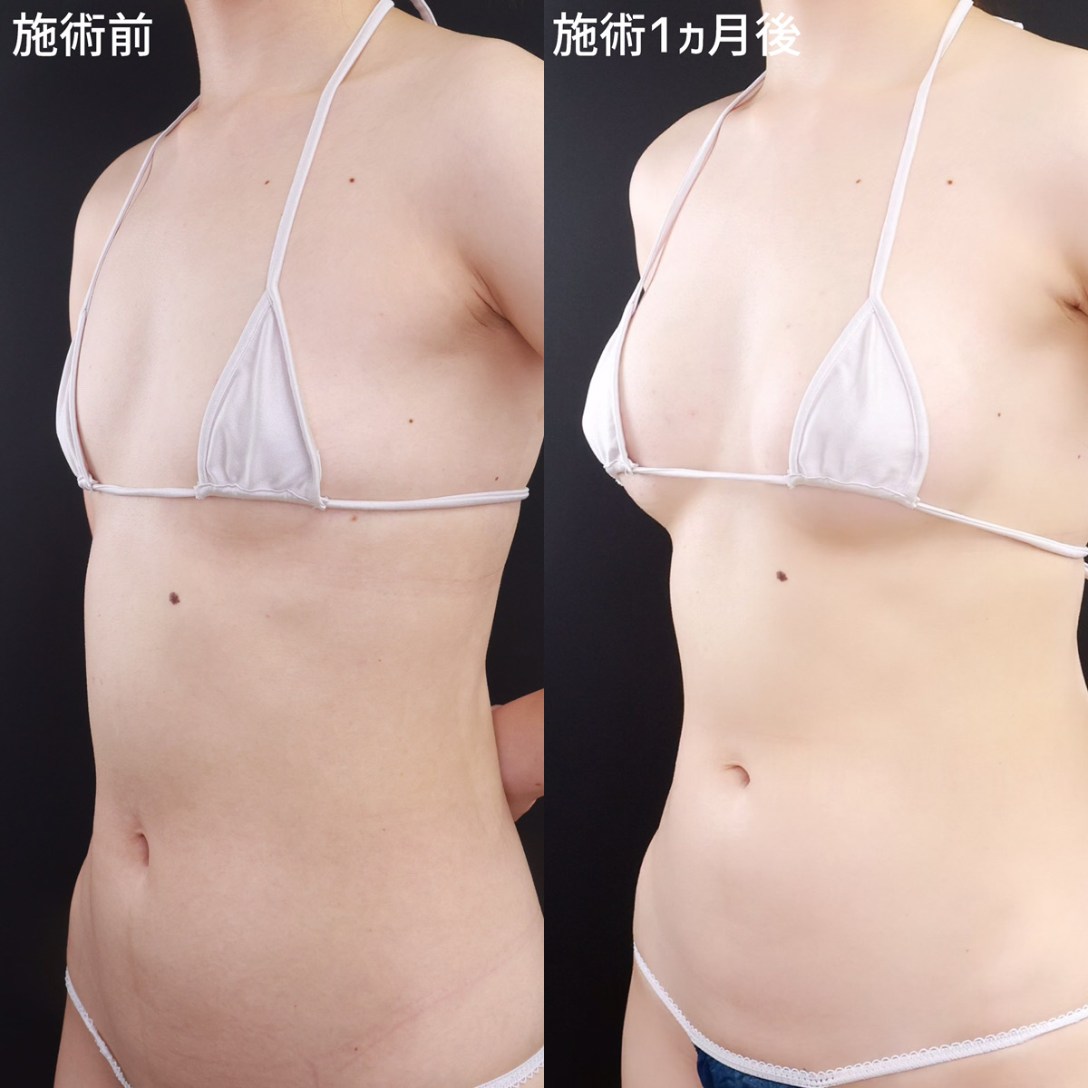 シリコンバッグ豊胸（人工乳腺バッグ）の症例写真 施術前後 