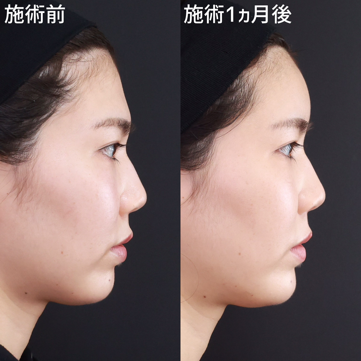 TAC式 ツヤ肌コラーゲンリフト®/おでこの脂肪注入（オルチャンデコ形成）/顎のヒアルロン酸注射の症例写真 施術前後 