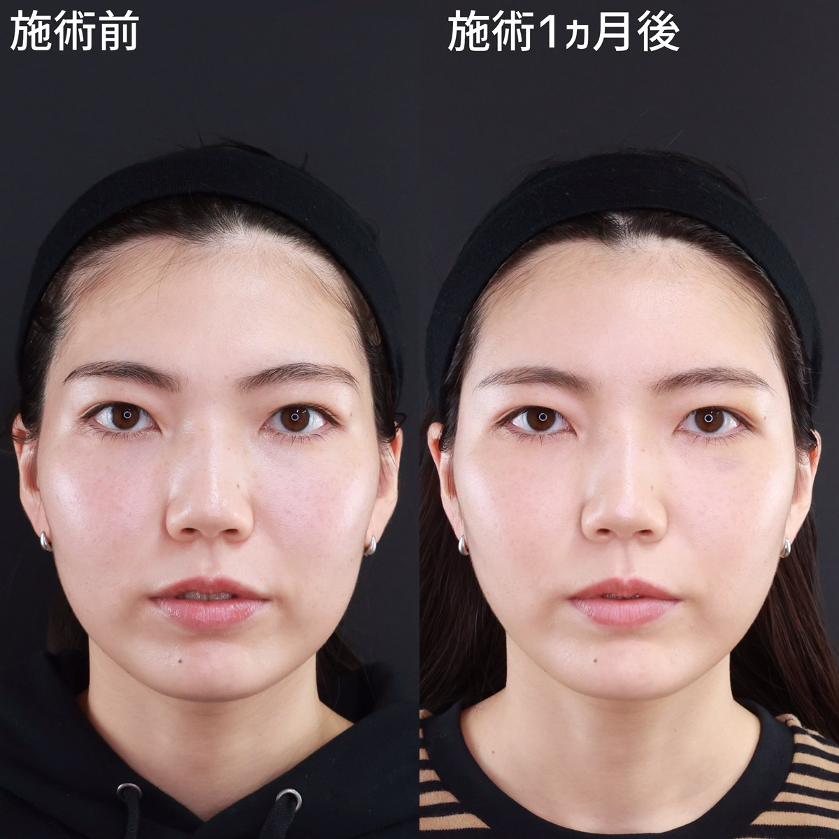 TAC式 ツヤ肌コラーゲンリフト®/おでこの脂肪注入（オルチャンデコ形成）/顎のヒアルロン酸注射の症例写真 施術前後 