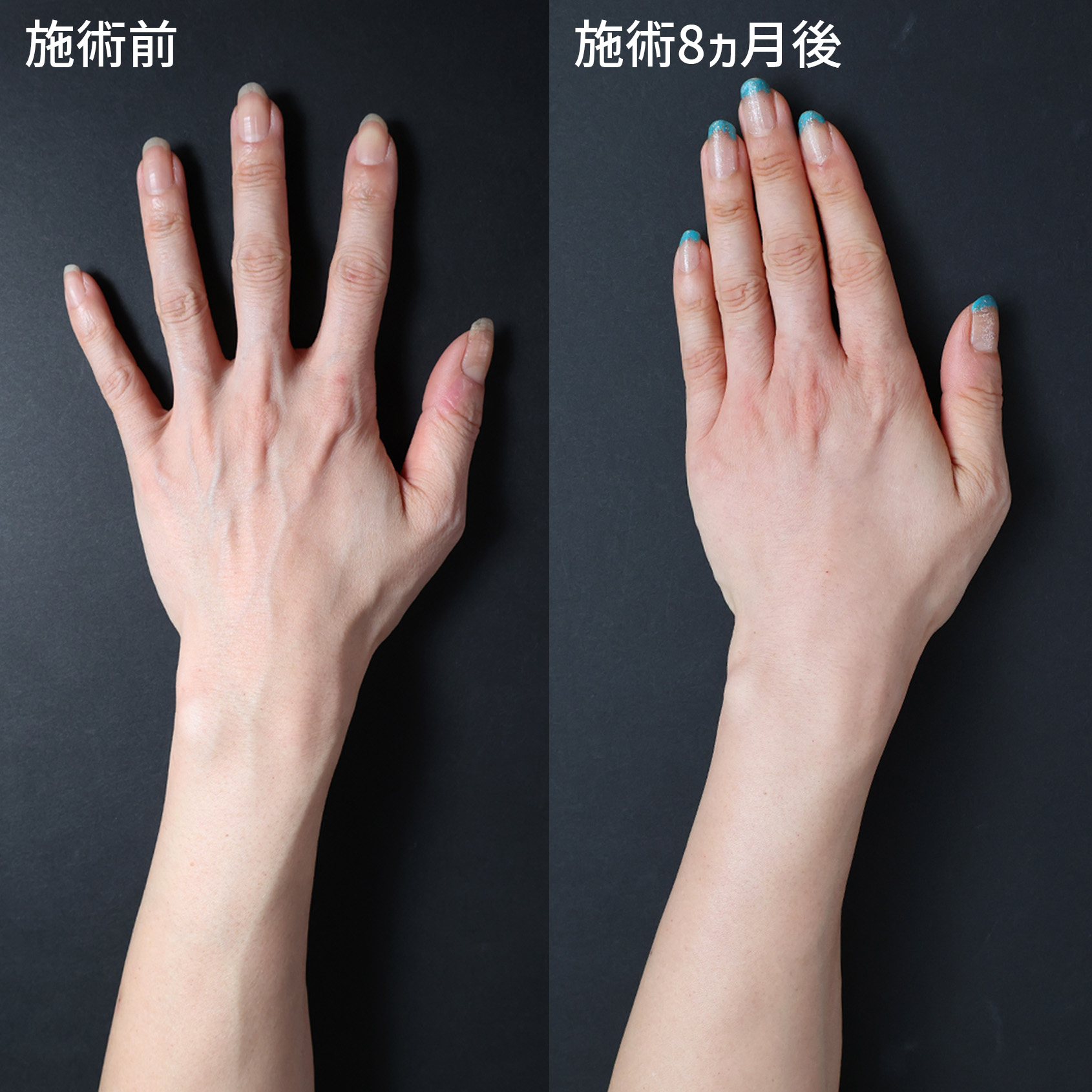 手の血管治療(ハンドベイン)の症例写真 施術前後