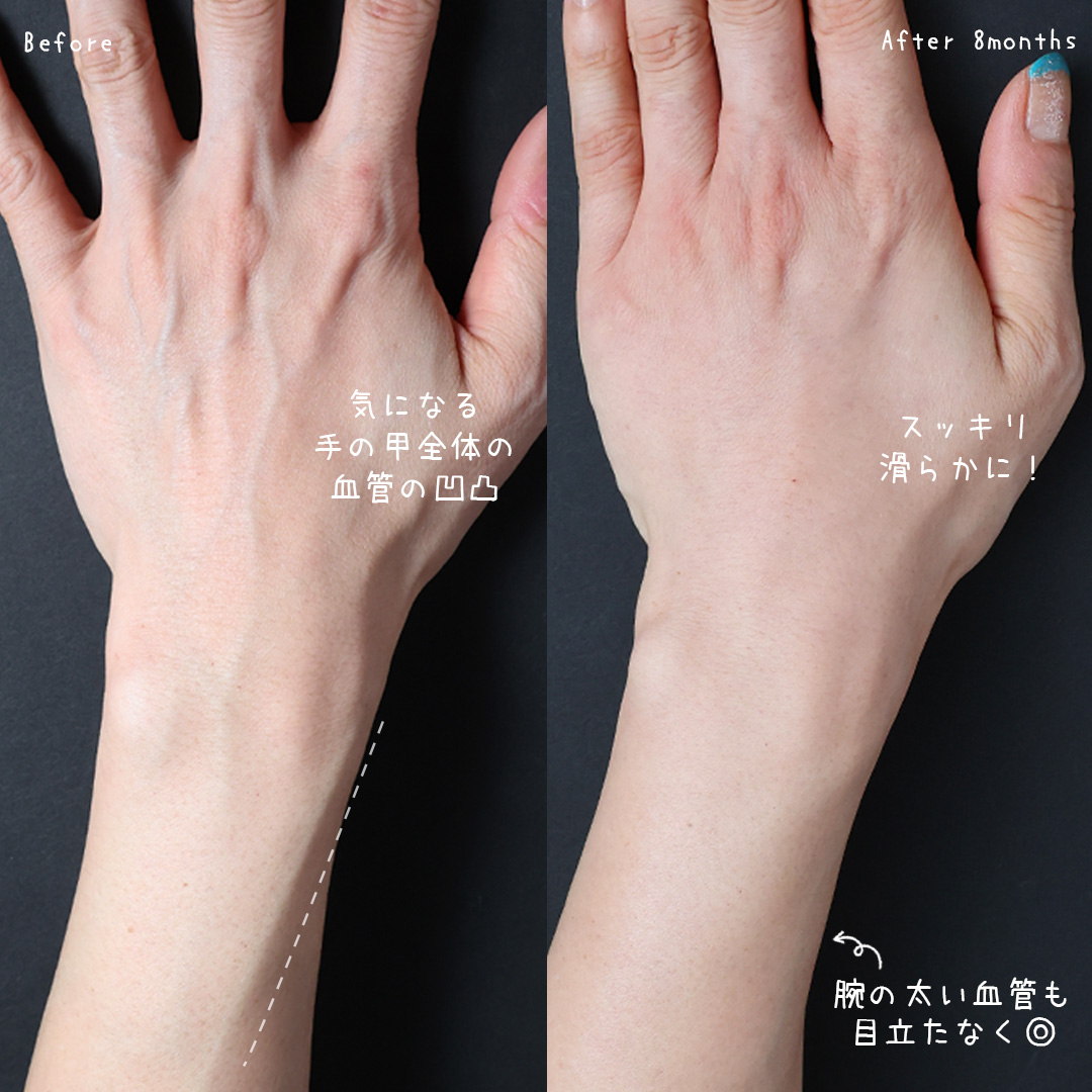 手の血管治療(ハンドベイン)の症例写真 施術前後