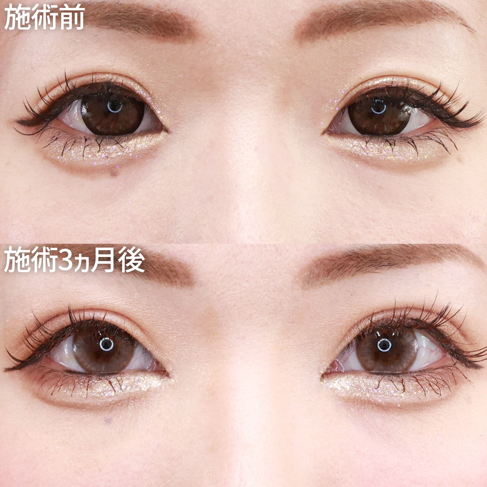 上眼瞼切開術/眼瞼下垂（目つき矯正）/目頭切開術の症例写真 施術前後 