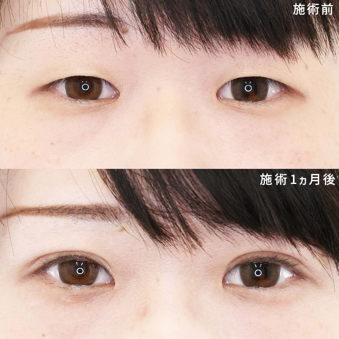 【二重埋没】美人度アップ！華やか二重