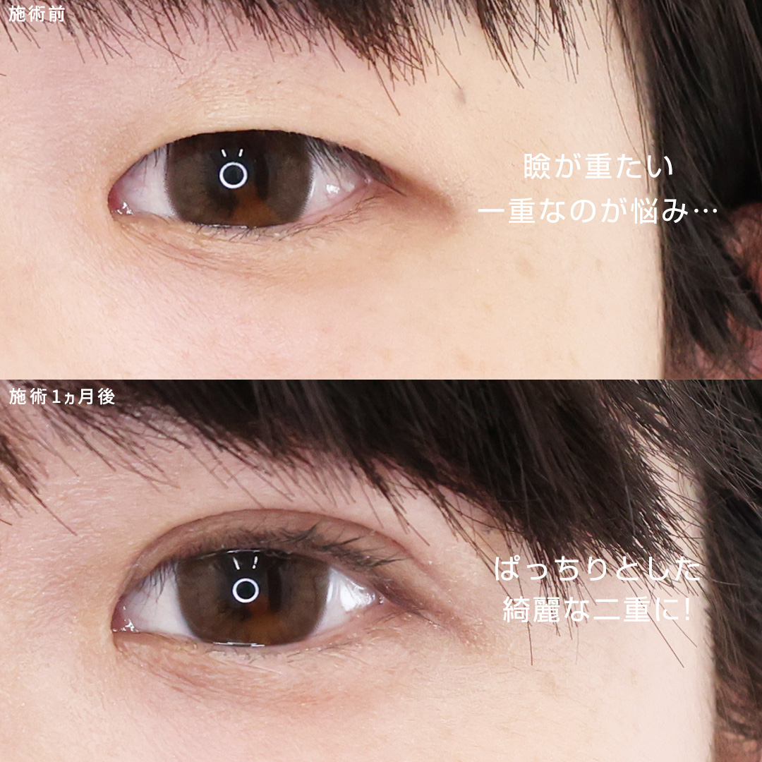 二重埋没法の症例写真 施術前後 