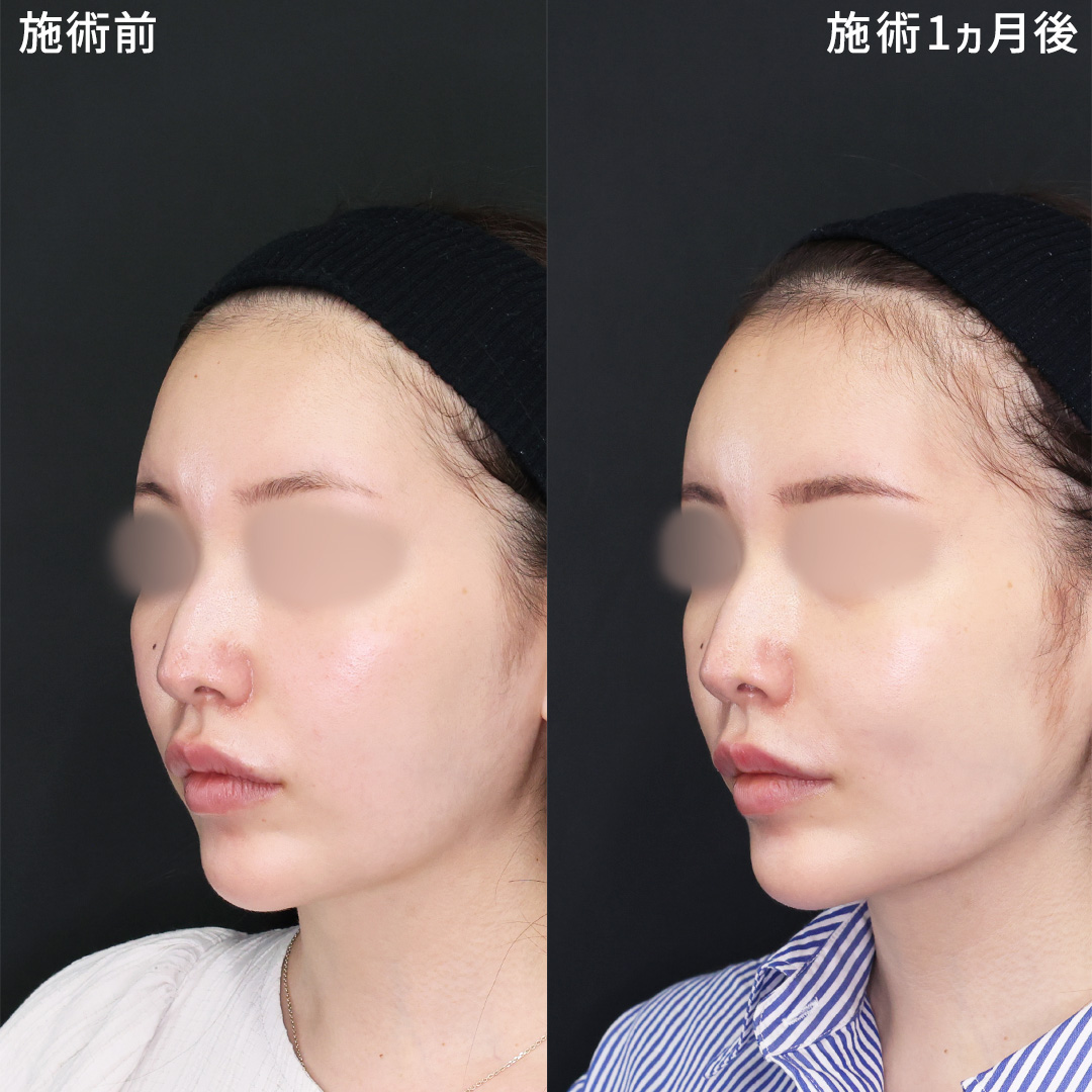 ≪糸リフト×額ヒアル≫お顔のトータルバランスを整える