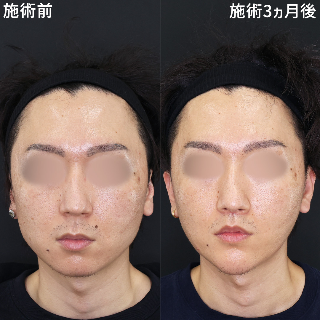 【人中×小顔】人中短縮と小顔の複合施術で洗練された印象に！