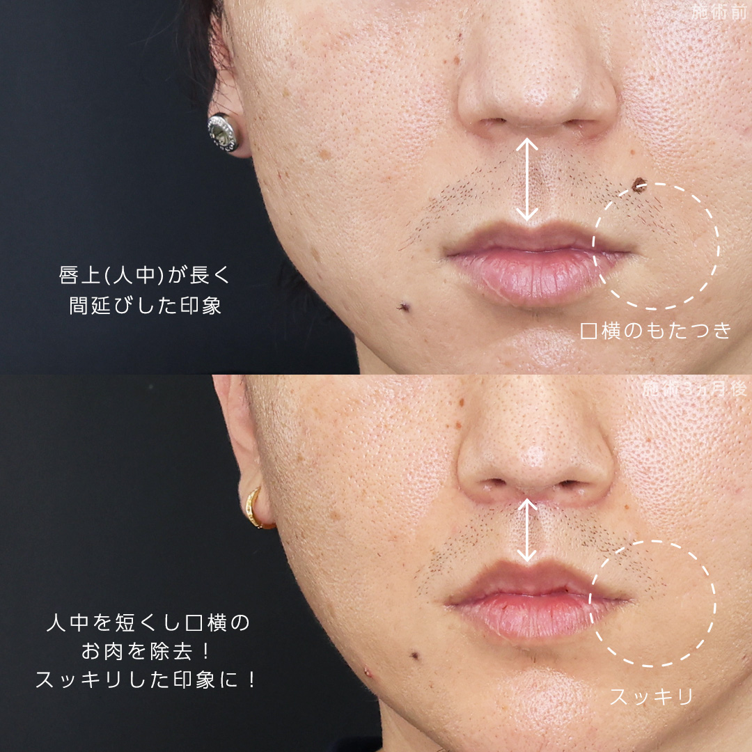 人中短縮術(リップリフト)・外側人中短縮術/口角挙上・リフト（マイクロ切開法・内側法/口内法）/TAC式 ツヤ肌コラーゲンリフト®の症例写真 施術前後 