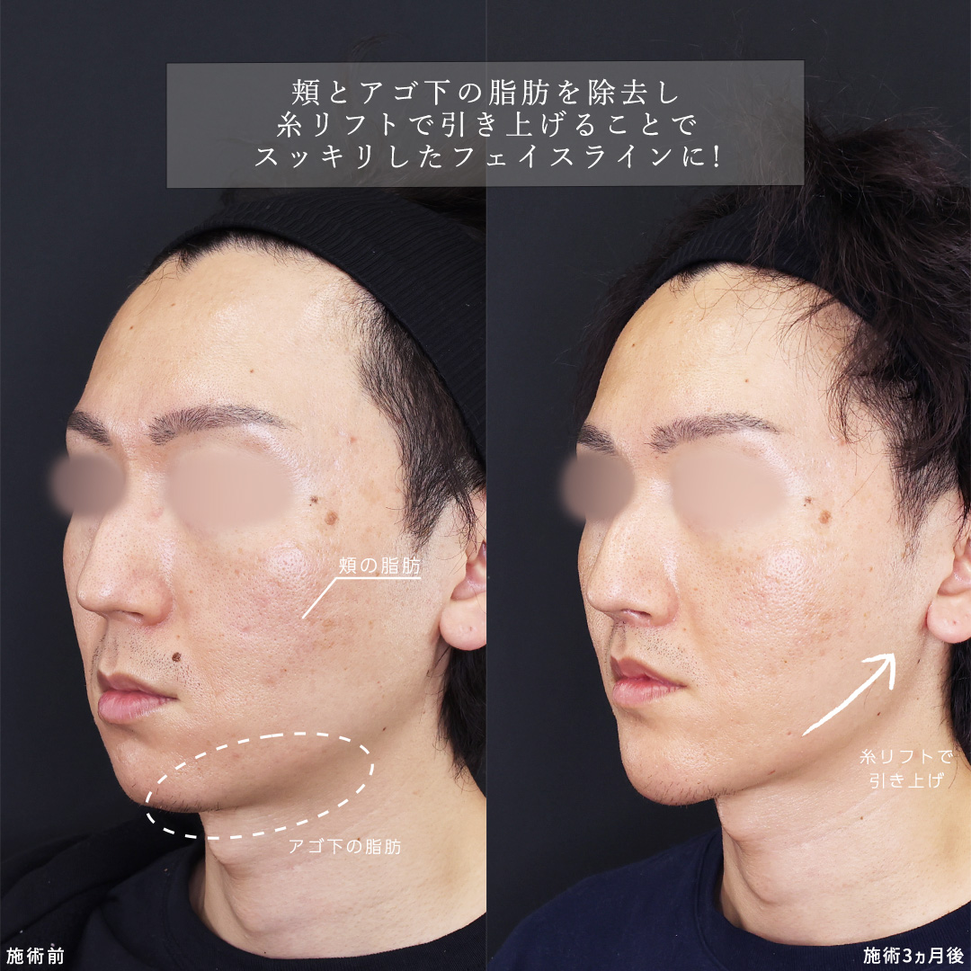 人中短縮術(リップリフト)・外側人中短縮術/口角挙上・リフト（マイクロ切開法・内側法/口内法）/TAC式 ツヤ肌コラーゲンリフト®の症例写真 施術前後 