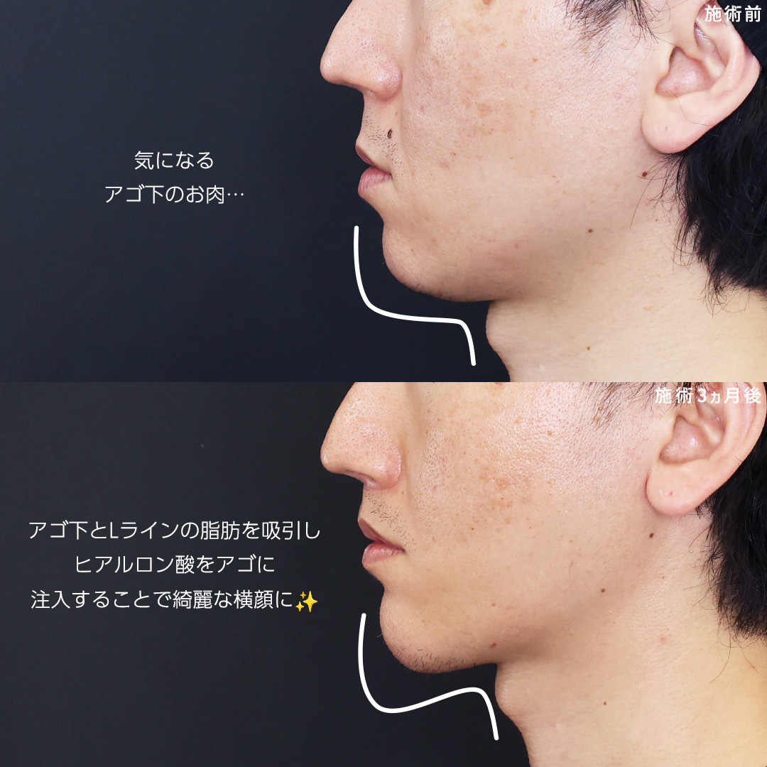 人中短縮術(リップリフト)・外側人中短縮術/口角挙上・リフト（マイクロ切開法・内側法/口内法）/TAC式 ツヤ肌コラーゲンリフト®の症例写真 施術前後 