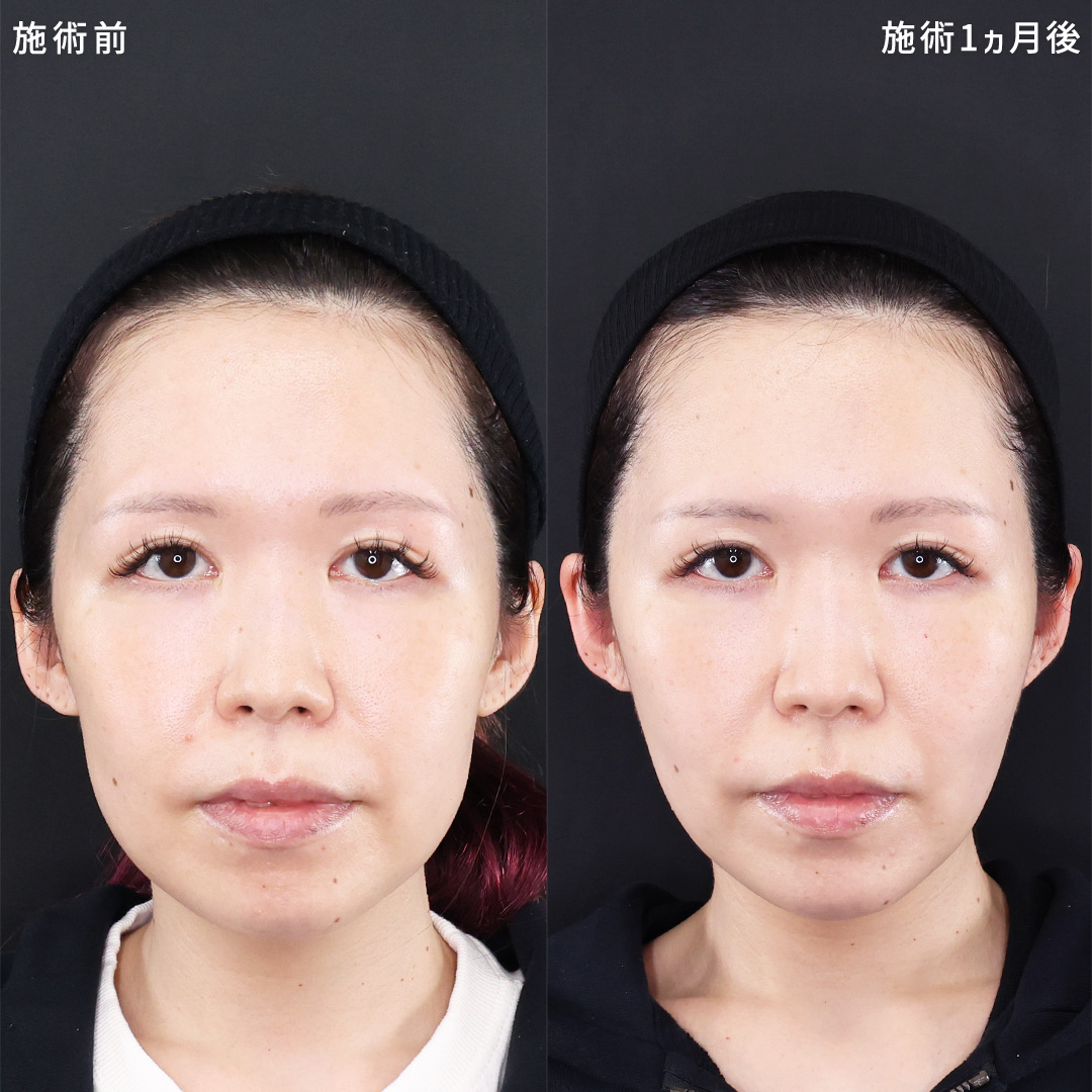 整形感のない自然なリフトアップ