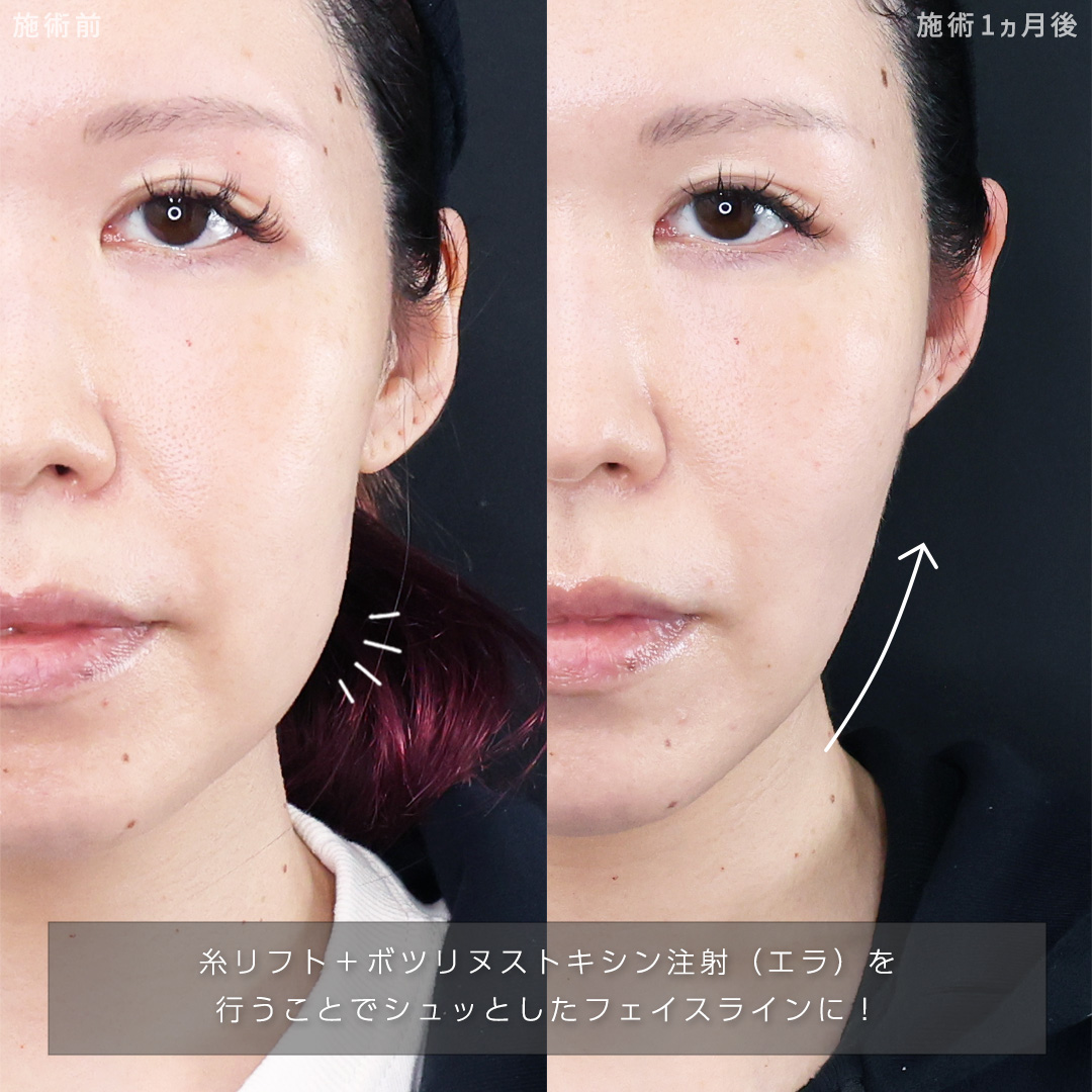 TAC式 ツヤ肌コラーゲンリフト®/TAC式 ショッピングリフト/顎のヒアルロン酸注射の症例写真 施術前後 