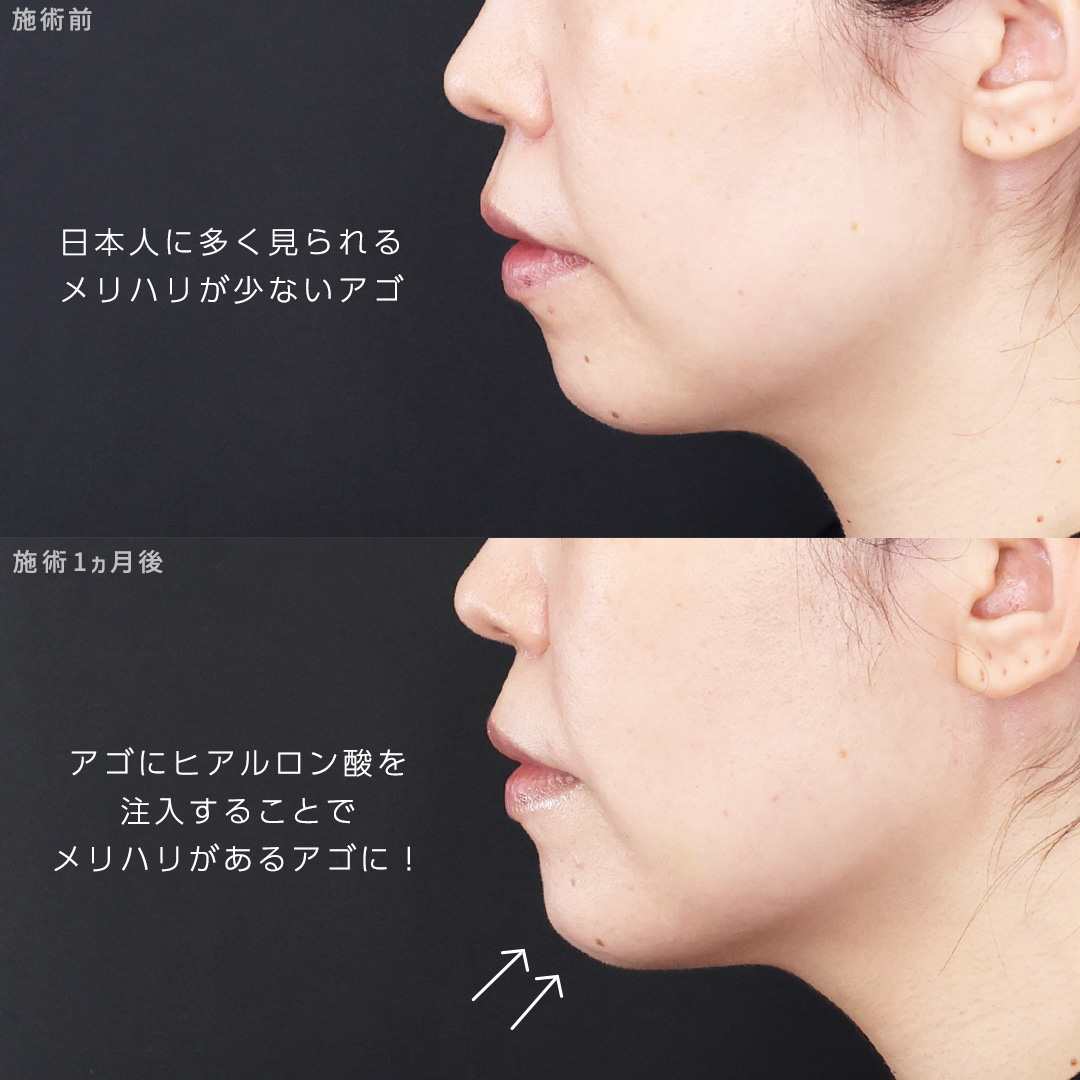 TAC式 ツヤ肌コラーゲンリフト®/TAC式 ショッピングリフト/顎のヒアルロン酸注射の症例写真 施術前後 
