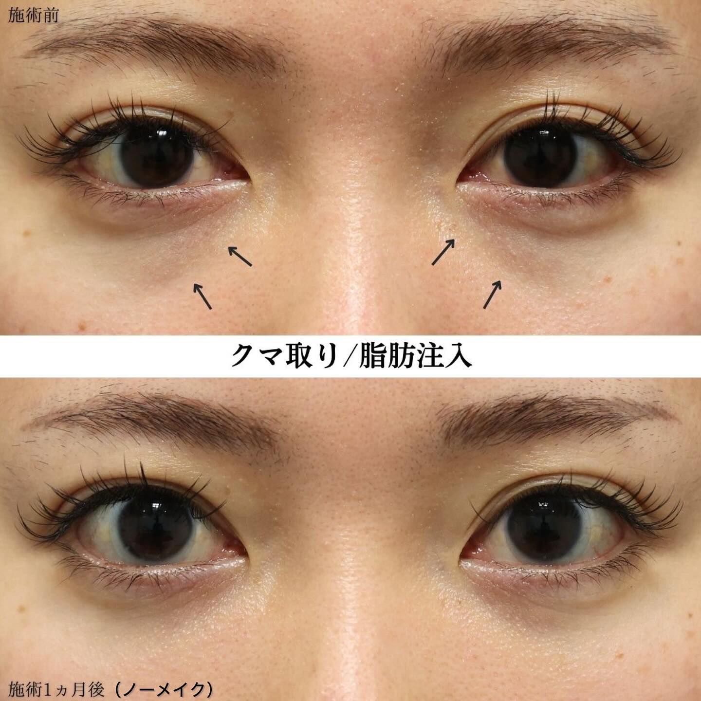 下眼瞼脱脂術(目の下のたるみ取り・目の下の脂肪ふくらみ取り)の症例写真 施術前後