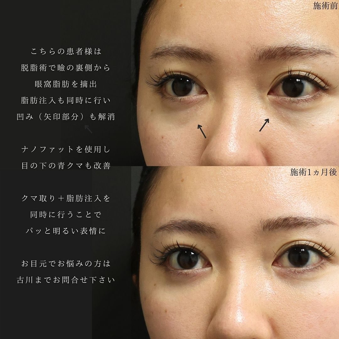 下眼瞼脱脂術(目の下のたるみ取り・目の下の脂肪ふくらみ取り)の症例写真 施術前後